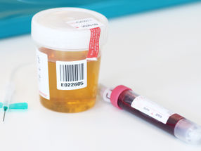 Krebsdiagnostik: Pinkeln statt Piksen?