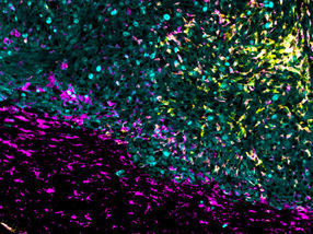 Un nouveau traitement s'attaque aux tumeurs cérébrales sous plusieurs angles